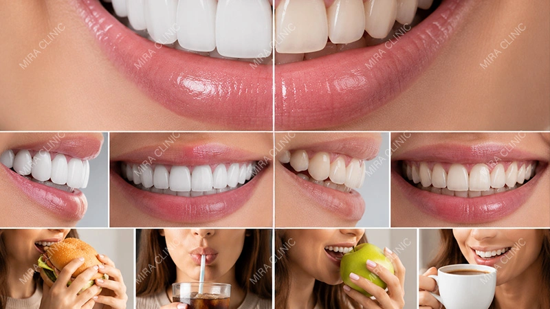 Fake Veneers